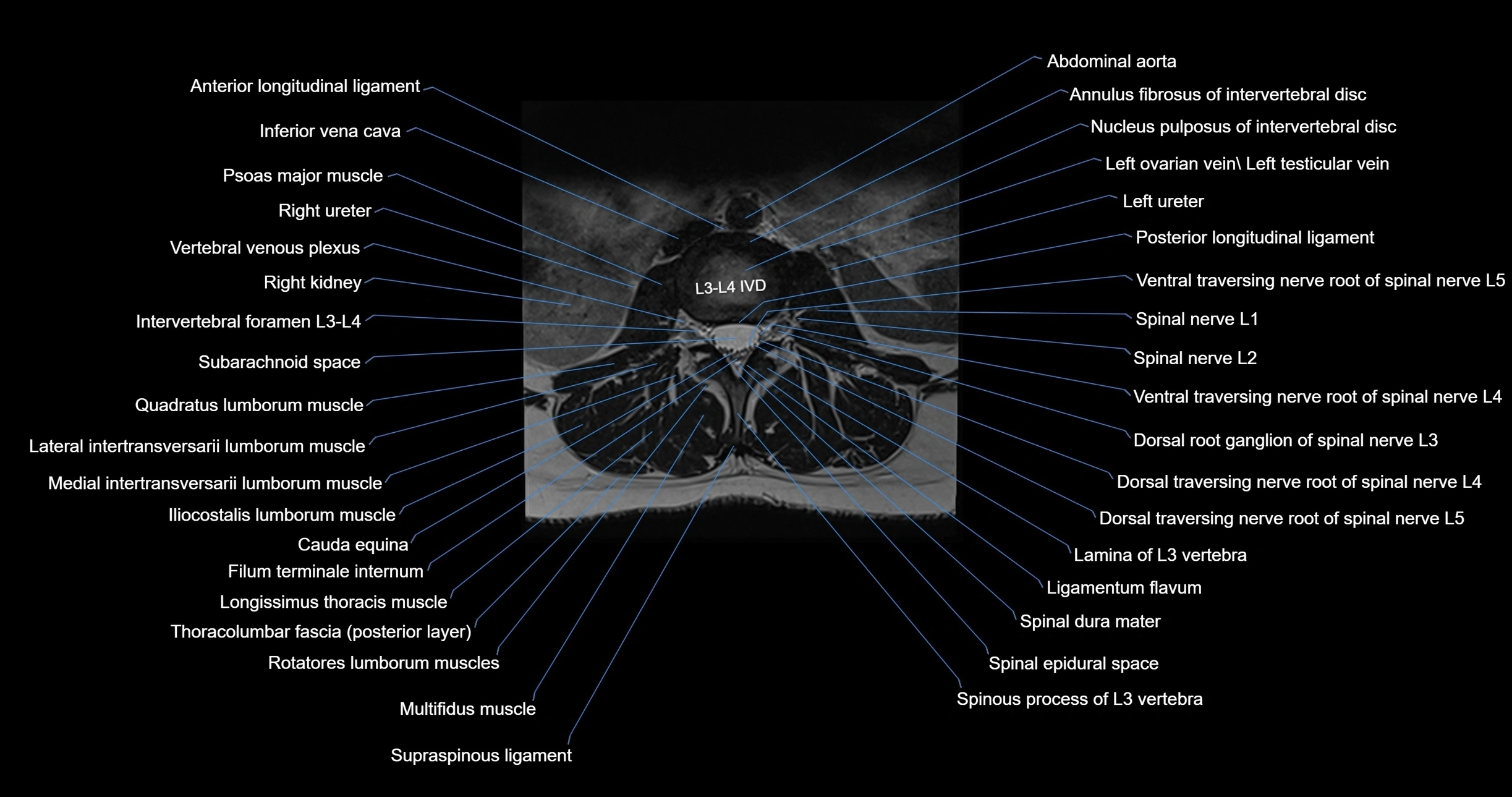 MRI lumbar spine axial cross sectional anatomy 3T radiology  image-img-00001-00025.webp